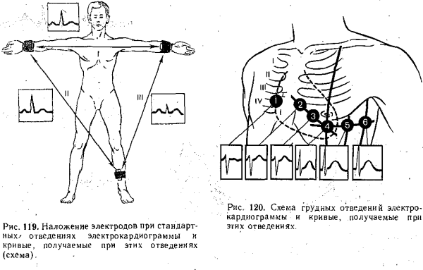 Наложение электродов при ЭКГ схема наложения