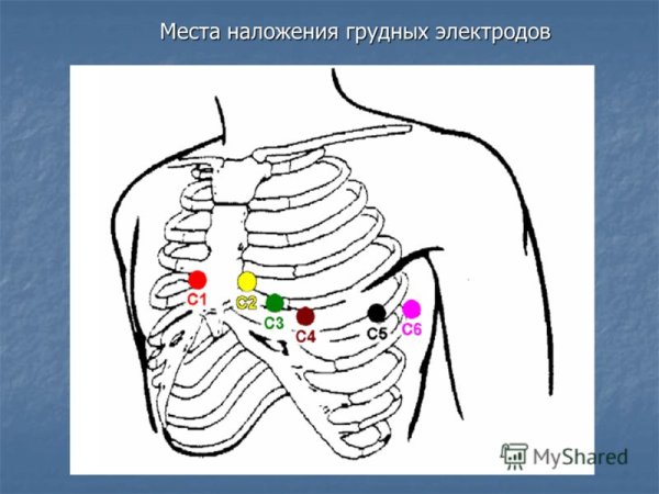 Наложение грудных отведений ЭКГ