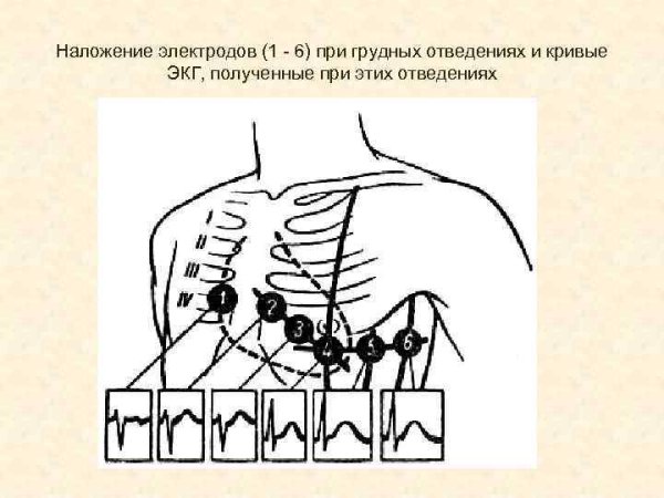 Электроды ЭКГ схема наложения электродов