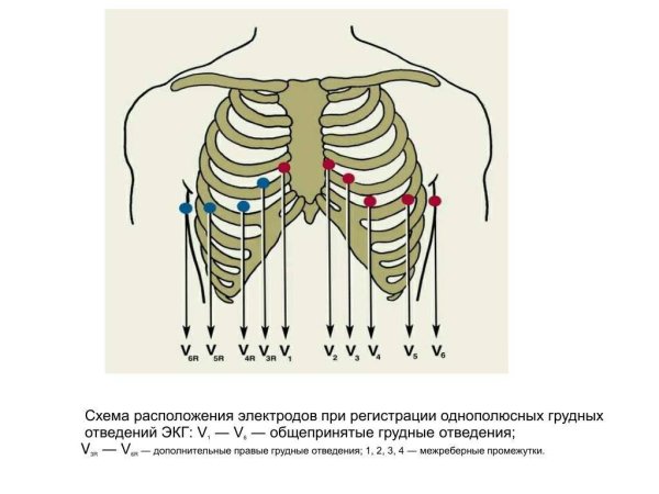 Наложение электродов при ЭКГ схема