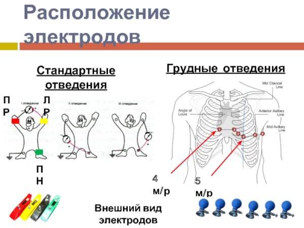 Расположение стандартных электродов ЭКГ