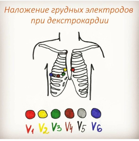 Схема наложения электродов при декстрокардии