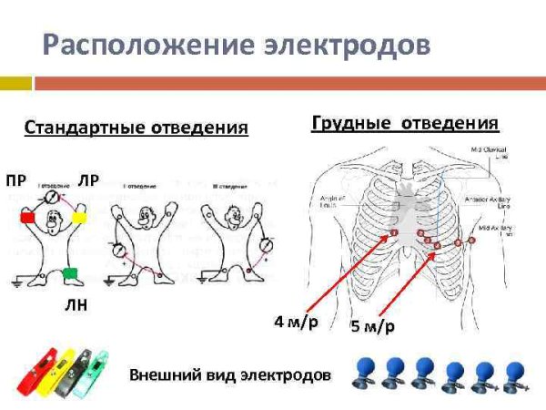 Постановка электродов ЭКГ отведения