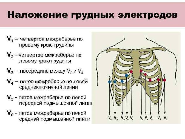 Наложение грудных электродов ЭКГ