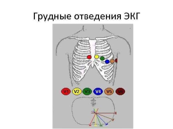 Грудные отведения на ЭКГ электроды