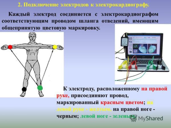 ЭКГ электроды наложение электродов