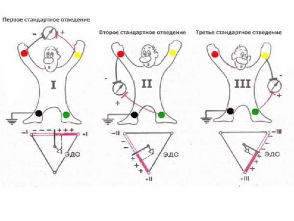 2 Стандартное отведение ЭКГ наложение электродов