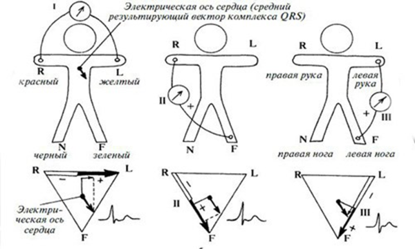 ЭКГ во втором стандартном отведении схема наложения электродов