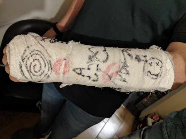 Креативный гипс на руке