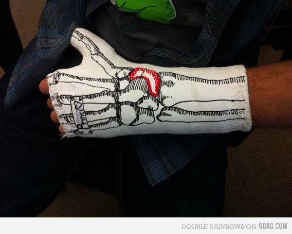 Разукрашенный гипс на ноге