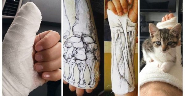 Разрисованный гипс на ноге