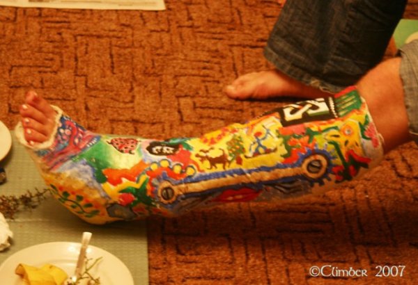 Разрисованный гипс на ноге