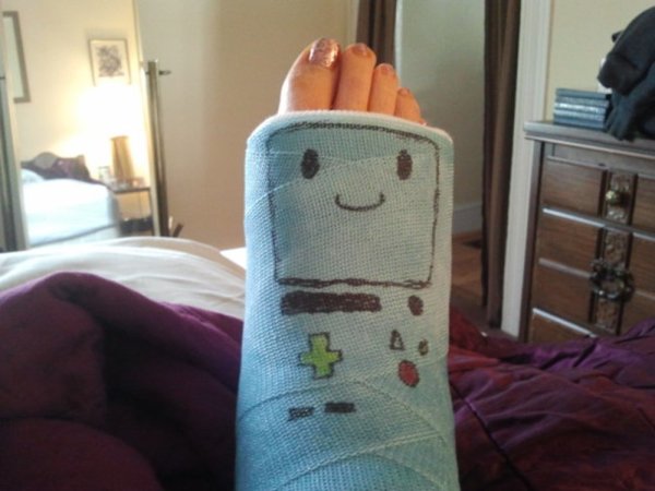 Разукрашенный гипс на ноге