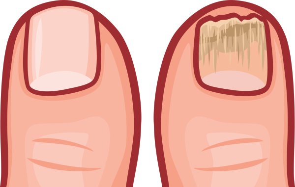 Грибок ногтей на ногах рисунок