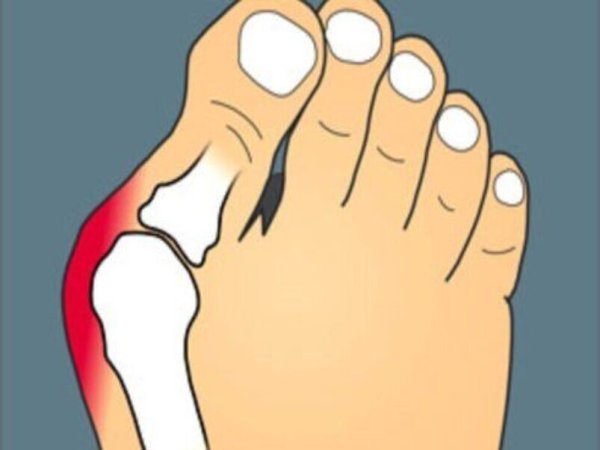 Онихокриптоз вросший ноготь