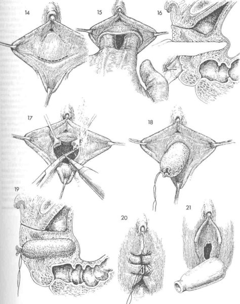 Вагинопластика трансгендерная