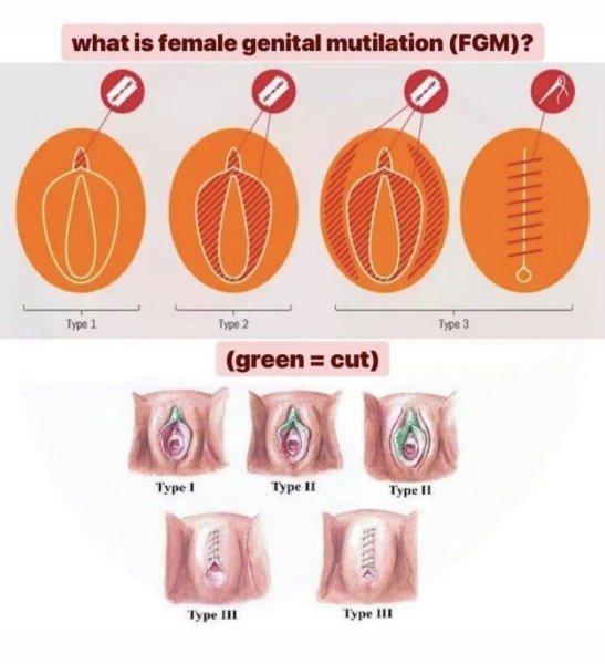 Обрезание у девочек схема что это такое