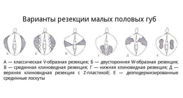 Малые половые губы лабиопластика