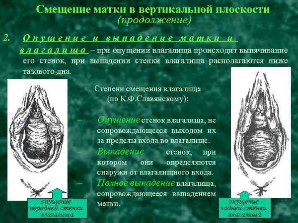 Опускание половых органов