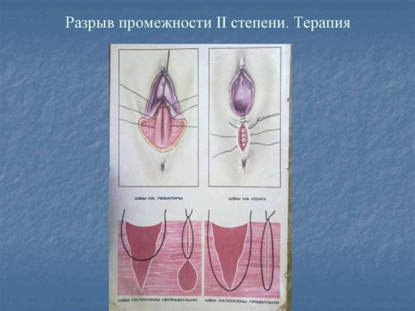 Разрыв промежности 2 степени шов
