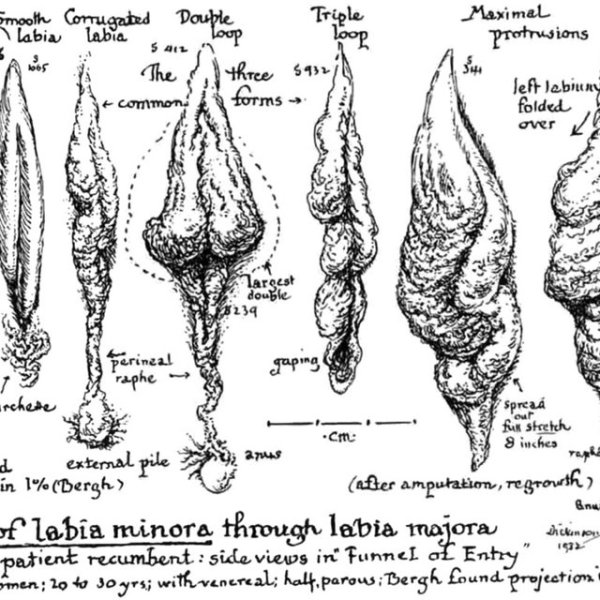 Малые половые губы торчат