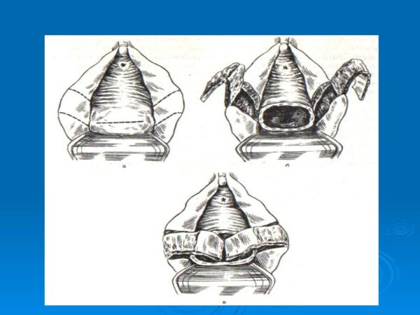 Большие малые половые губы