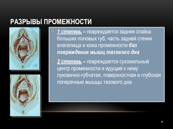 Степени разрыва промежности