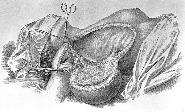 Мастэктомия по Холстеду-Майеру